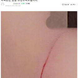 초딩 4학년이 연필로 초딩 2학년 얼굴 그어놓음 ㅎㄷㄷ