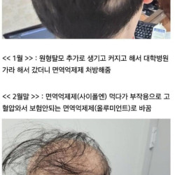 급성 탈모로 여친한테 차인 남자