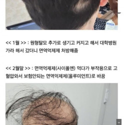 급성 탈모로 여친한테 차인 남자