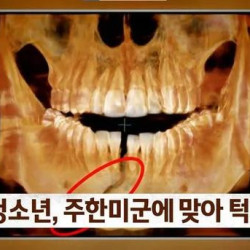 주한 미군 주먹에 10대 학생 '턱뼈' 부 서져